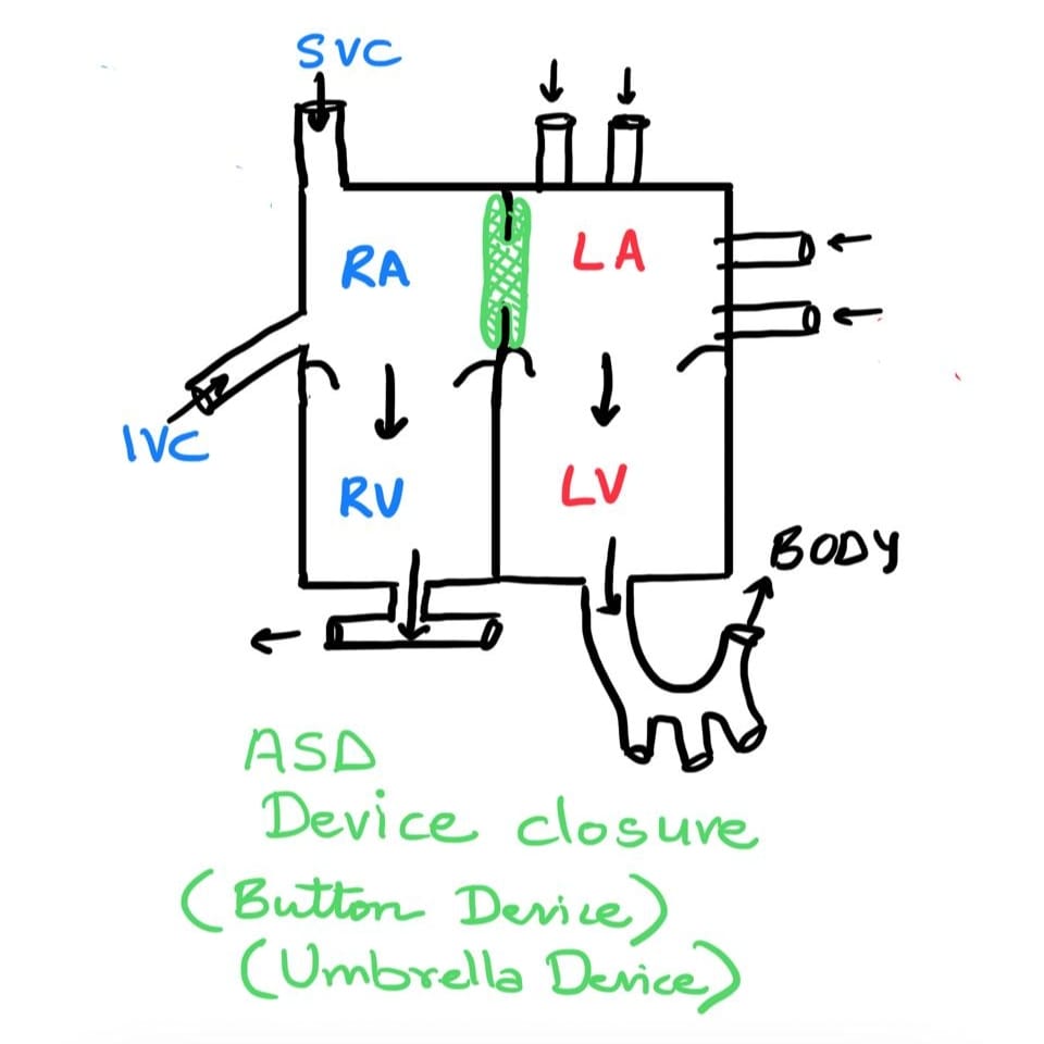 ASD device closure sketch showing umbrella or button device in atrial septum.