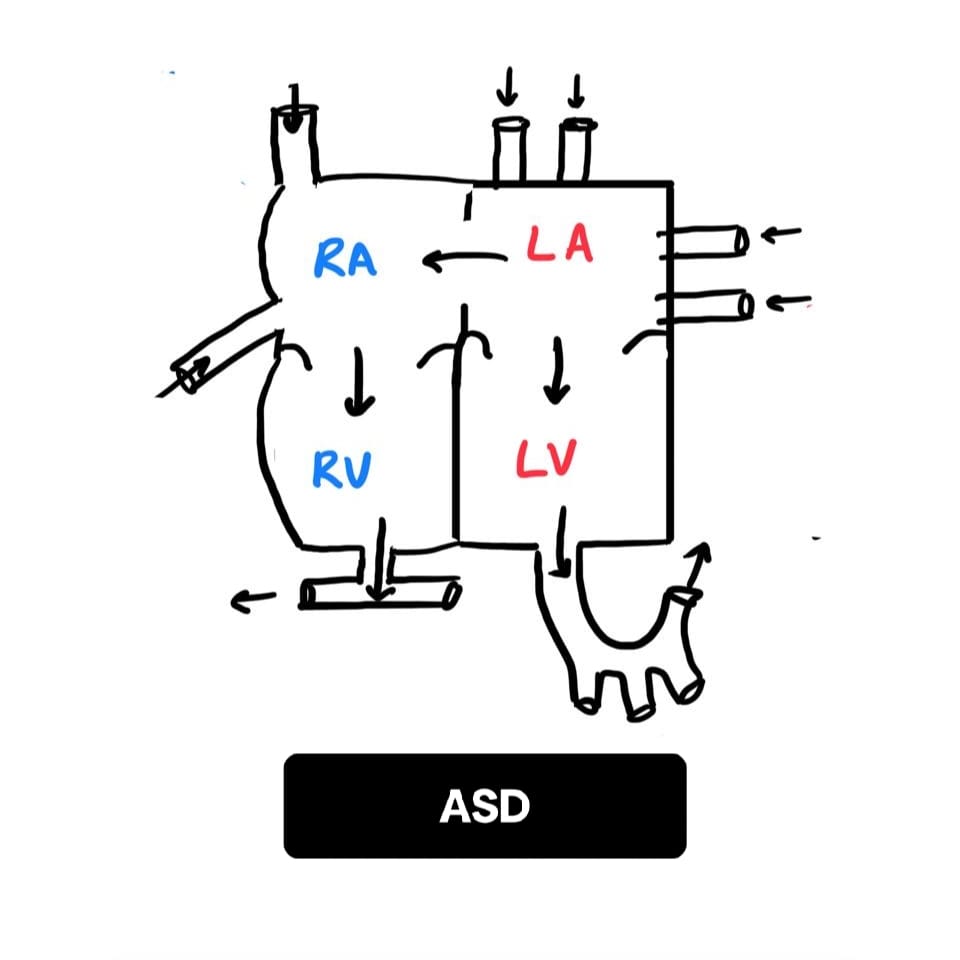 ASD diagram showing shunt between left and right atria.