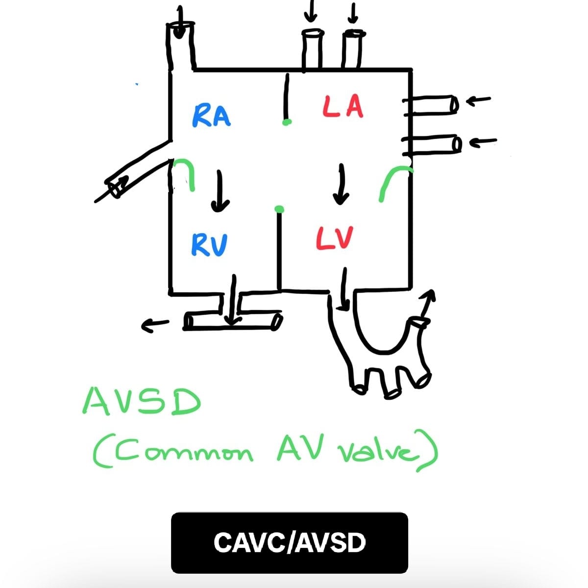 CAVC AVSD diagram showing common AV valve with septal defects.