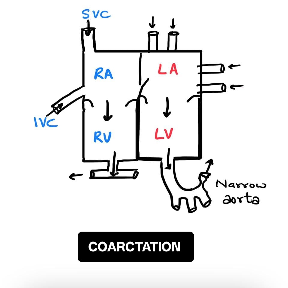 Coarctation diagram showing narrowed aortic segment.