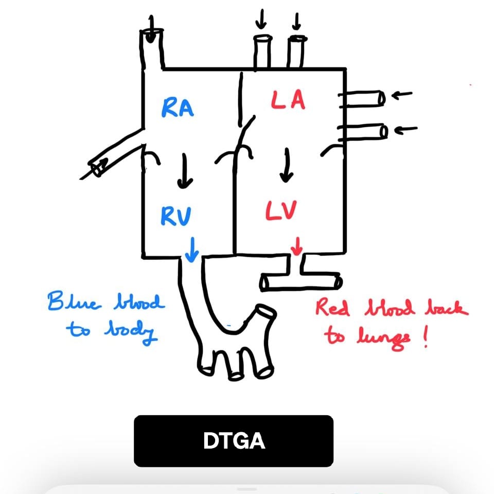 DTGA diagram showing parallel circulation with blue blood to body and red blood back to lungs.