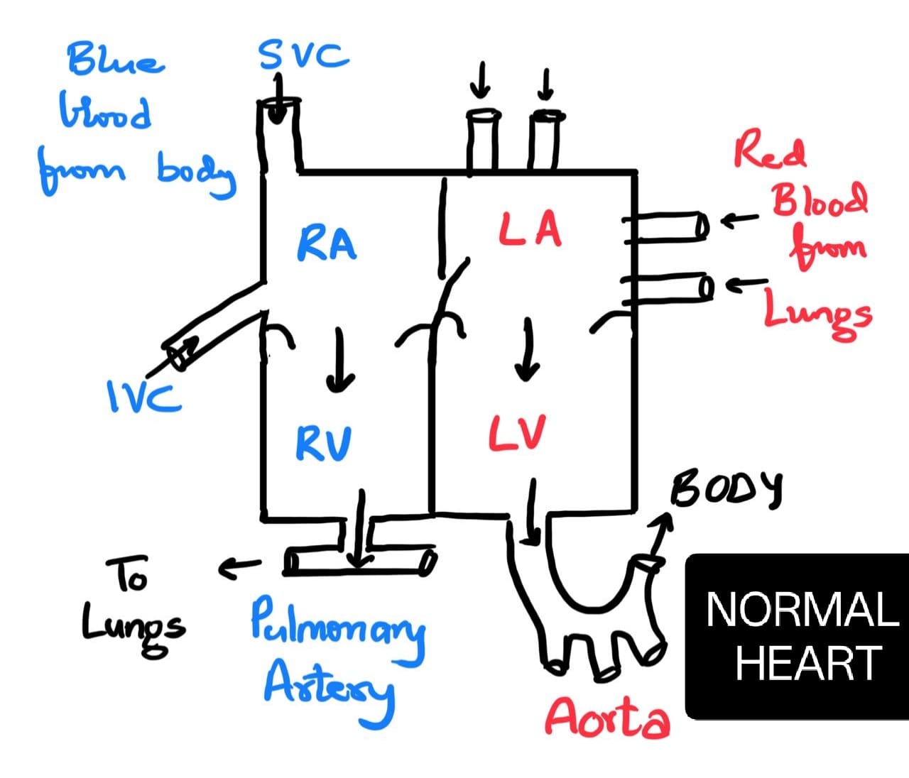 Normal heart flow diagram showing right and left heart chambers, pulmonary artery, and aorta.