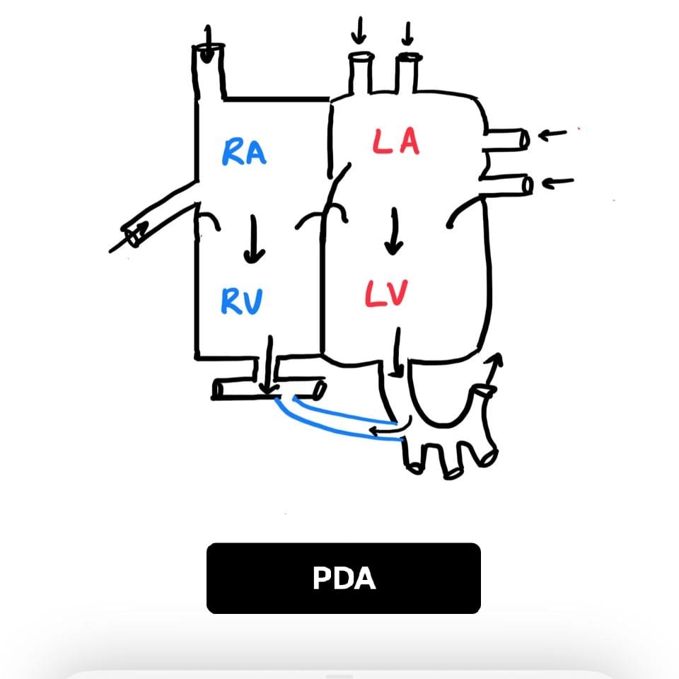 PDA diagram showing persistent ductal connection between aorta and pulmonary artery.