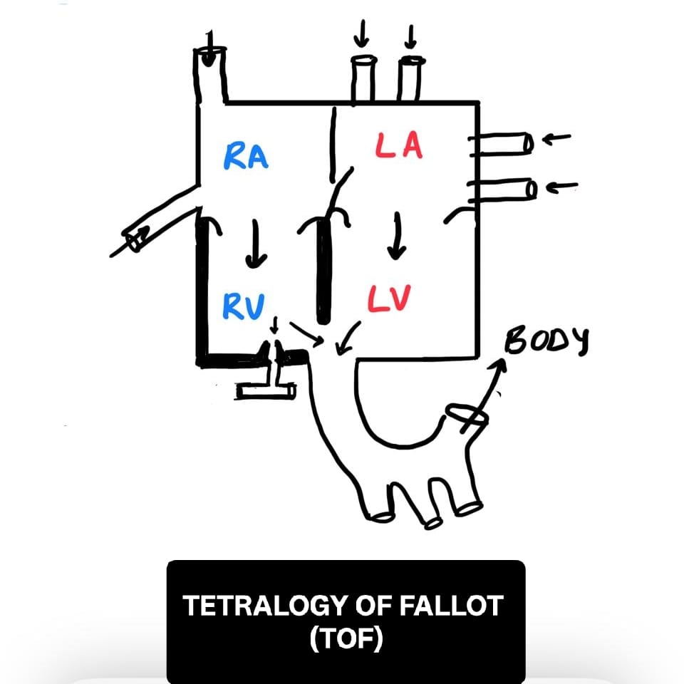 Tetralogy of Fallot diagram showing right-sided outflow obstruction and mixed flow.