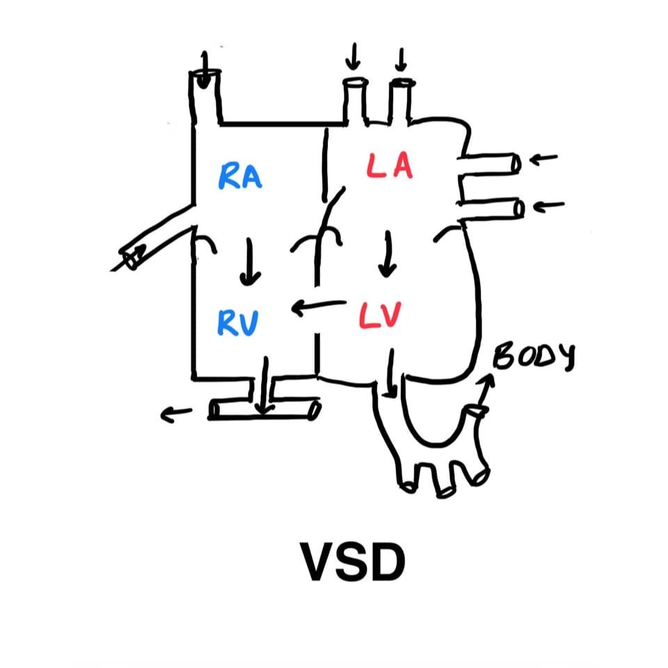 VSD diagram showing shunt between left and right ventricles.